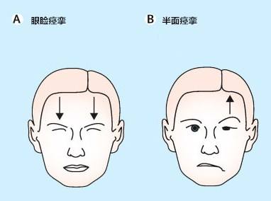 面肌痉挛早期辨别图片