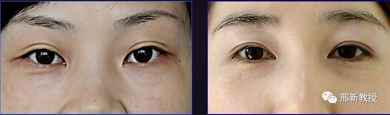 下睑成形术术式的选择