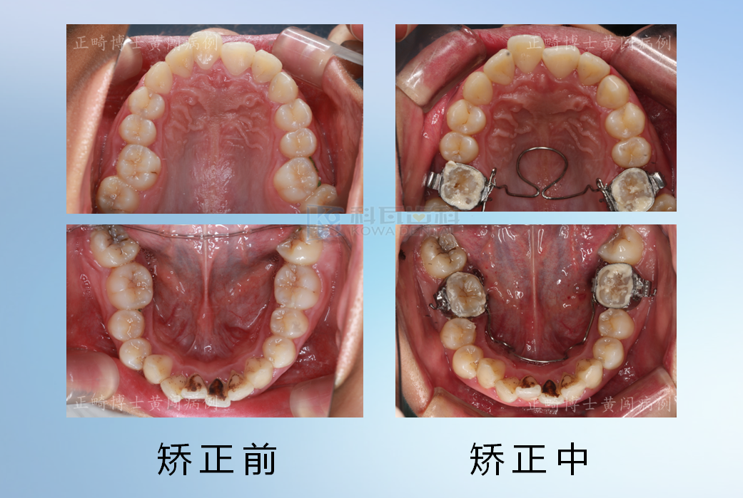 那么采用我们这种传统的腭杆或者舌杆,来进行扩弓,第一兼顾了美观
