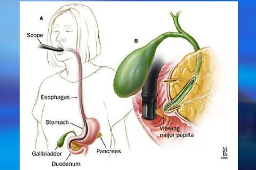 ercp不仅仅是检查,竟然还能做这么多治疗!