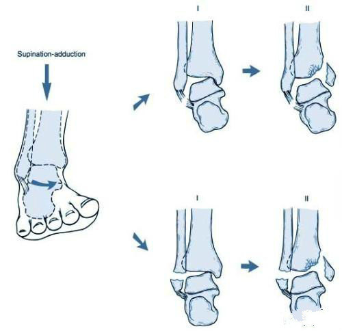 不同的踝关节类型以及骨折的碎裂程度,关节面的平整程度,骨折块的移位