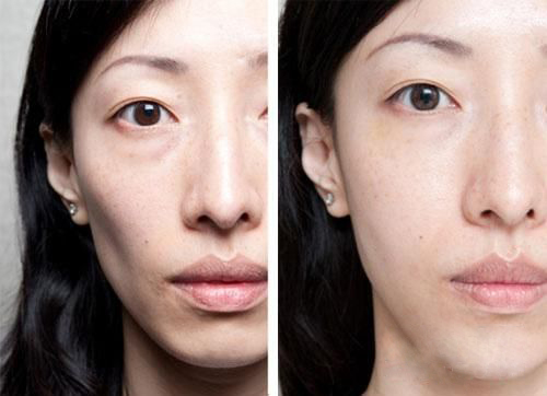 面部凹陷显老态,怎么办?