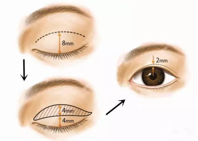 双眼皮的宽度有较宽,适中和较窄三种:2,如何设计双眼皮宽度?