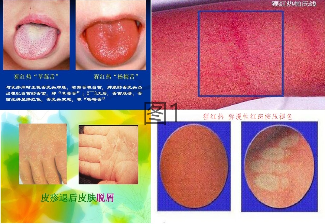 风疹鉴别诊断图片