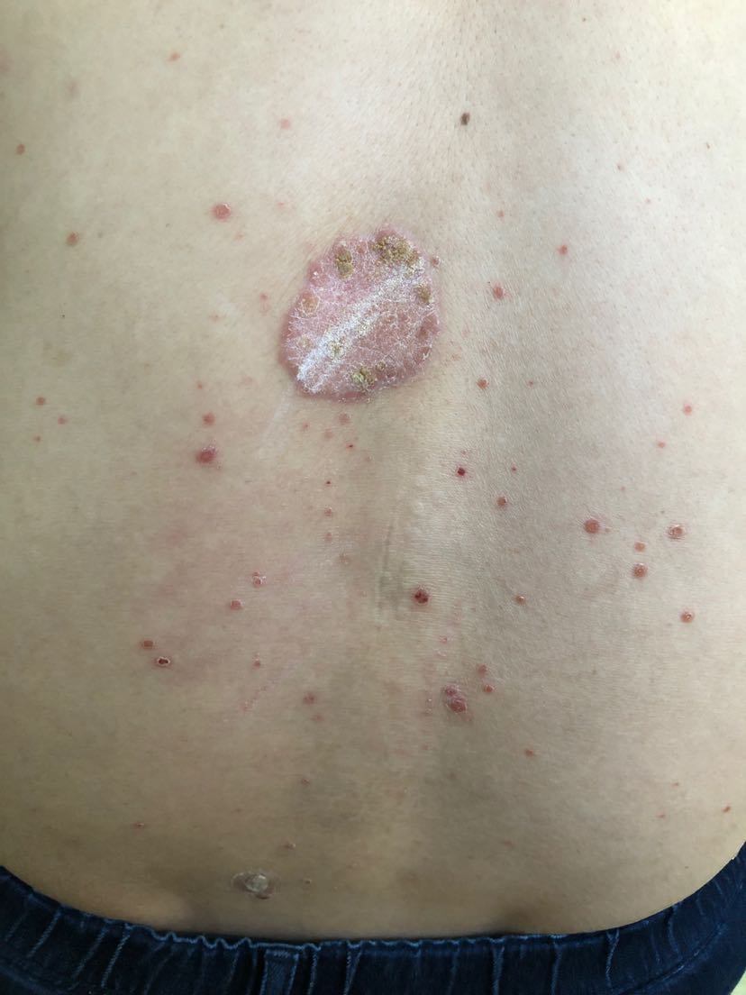 银屑病患者的治疗不建议用副作用太大的治疗方法目前该患者接受的治疗