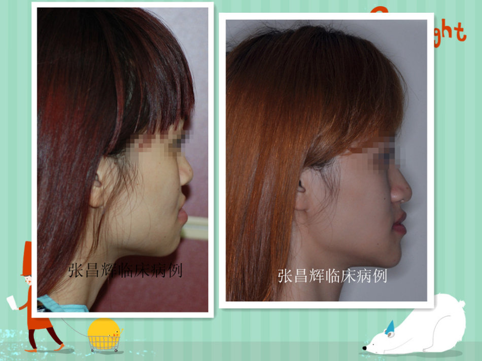 成人骨性反颌掩饰性正畸治疗