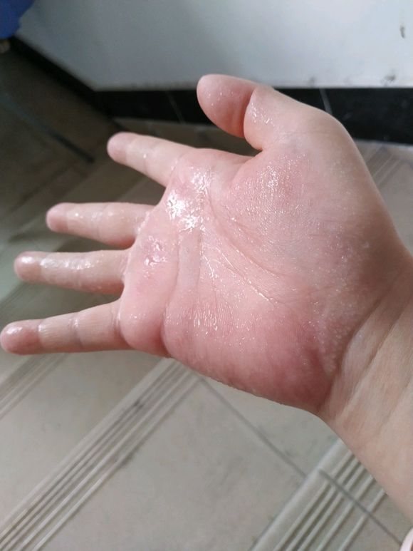 男的手容易出汗是什么原因 李杨主治医师 爱问医生
