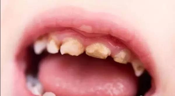 部分小朋友牙齿表面有白色或微黄的斑点,医生会告诉你这是脱矿现象,是