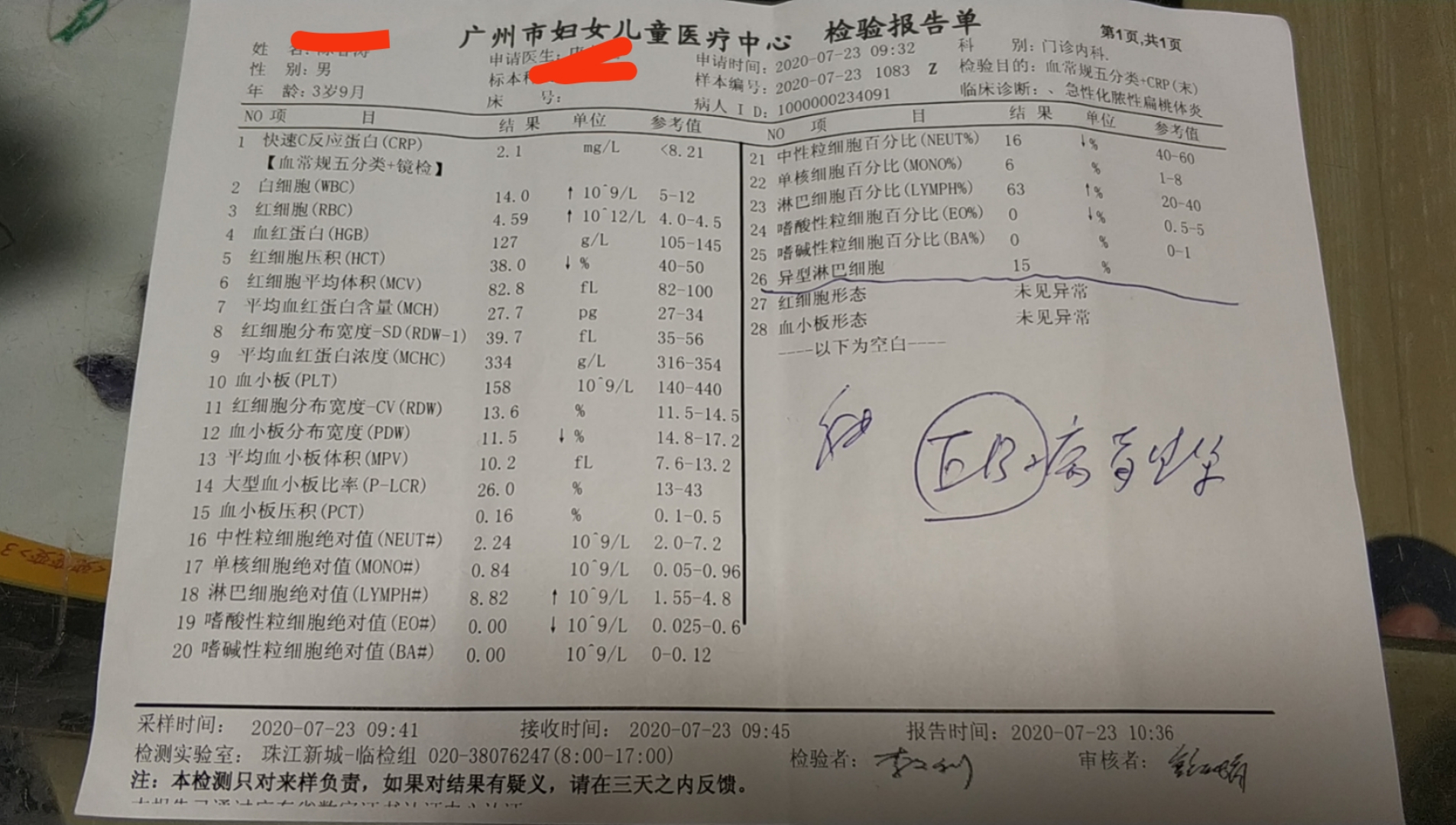 诊断:传染性单核细胞增多症辅助检查:血常规:wbc 14