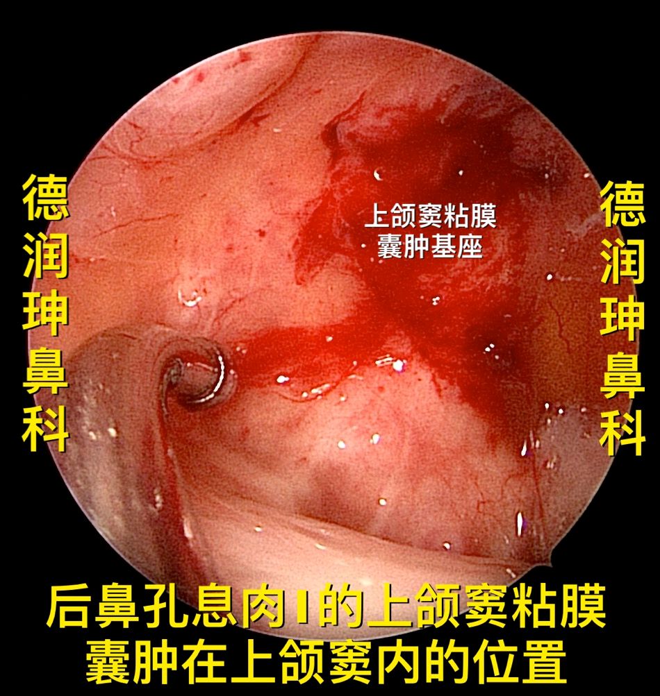 青少年后鼻孔息肉为什么会复发