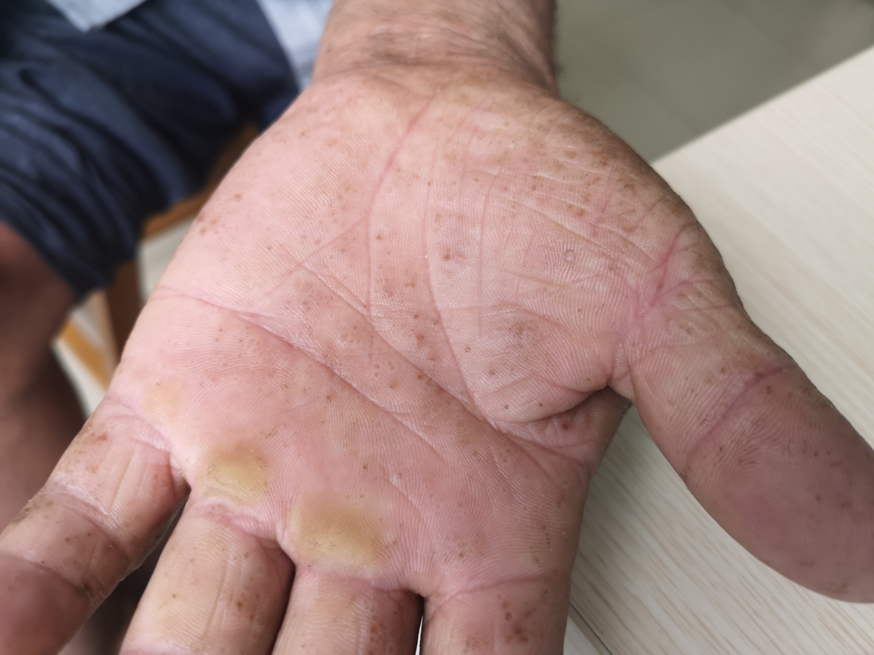 稻农皮炎—职业性接触性皮炎