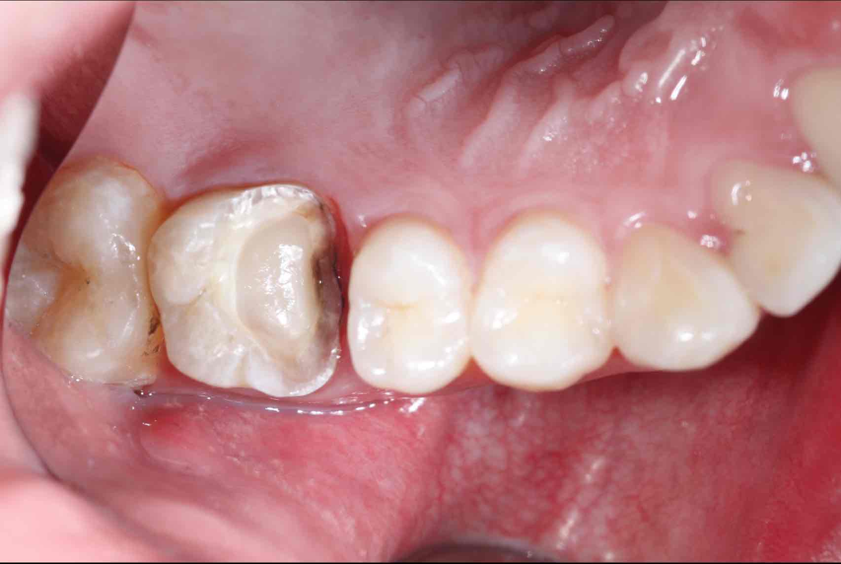 拆除后窝洞内已经发现龋坏并且银汞材料对牙本质造成了染色我们可以