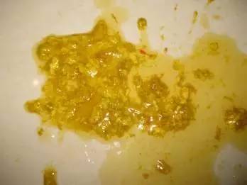 ②大便呈泡沫样:说明奶中淀粉类或糖类物质较多.