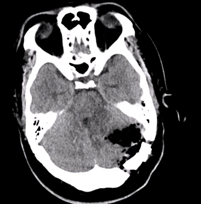 小脑血管母细胞瘤