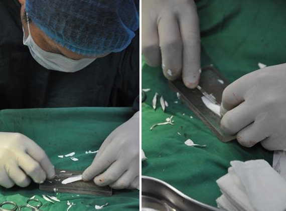 膨体隆鼻感染率高?难以取出吗?