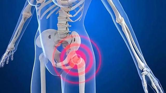 髋关节疼起来真要命,到底为什么这么痛?要怎么治疗?