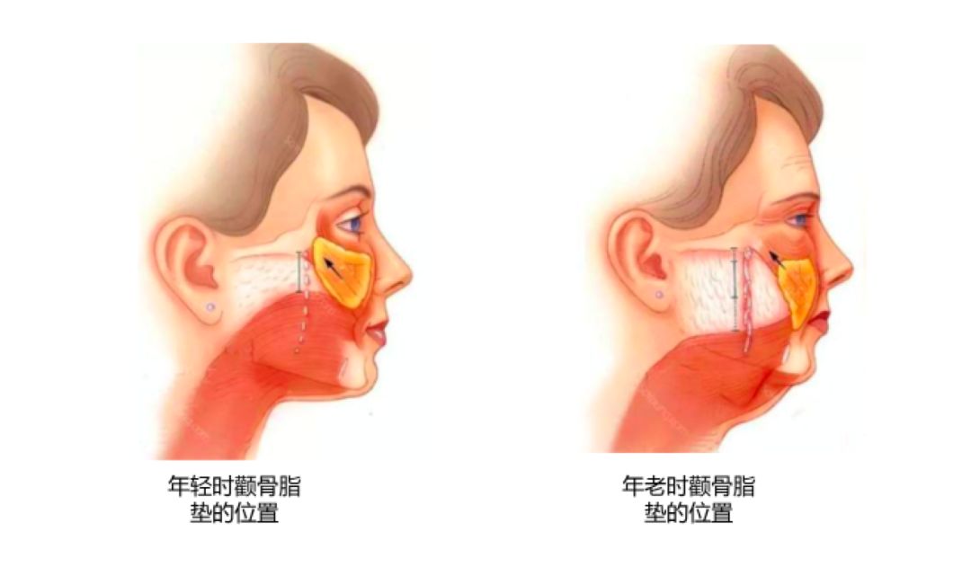随着年龄的增长,颧脂肪垫慢慢下垂.