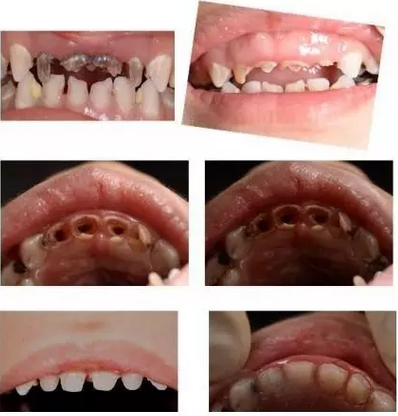 14岁的孩子,一口牙像齿轮,竟然是这个原因.