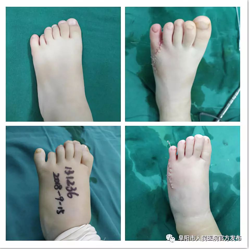 手足先天畸形关乎孩子的未来选择正规的医院进行正规的治疗才是关