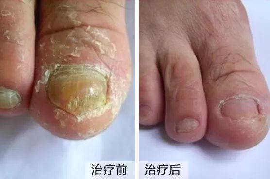 今日问答灰指甲街边小店真的能治好吗