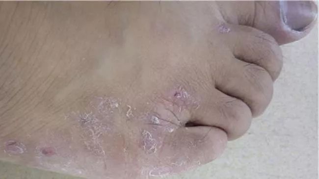 感染,出现脓疱,溃疡,并继发急性淋巴管炎,淋巴结炎,蜂窝织炎或丹毒