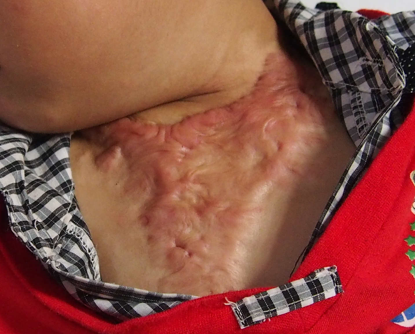 什么是疤痕体质