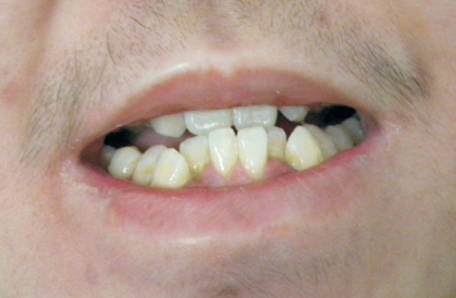 可能是单侧咀嚼所致!