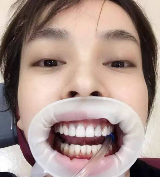 吴昕也说自己为了牙齿连续三年跑医院,还晒出自己矫正牙齿的照片!