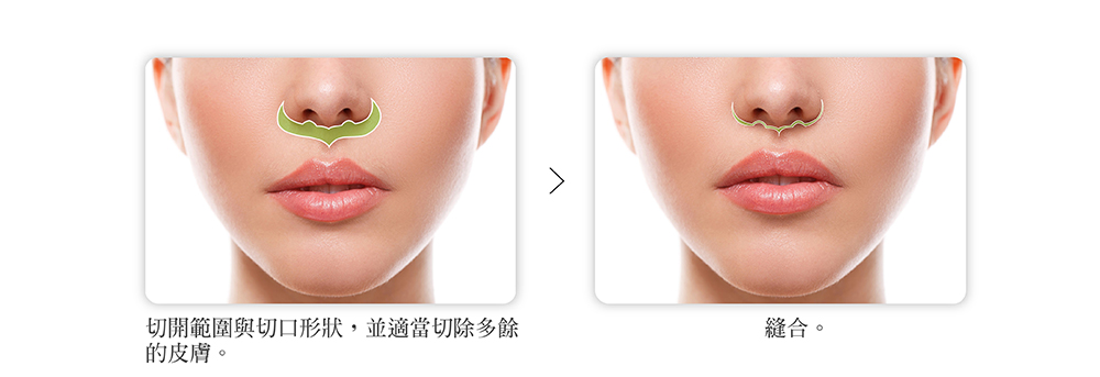 人中缩短手术介绍