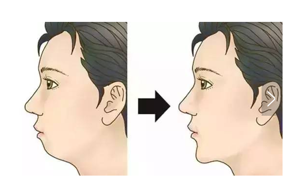 32,轻微的小颏畸形,但牙齿咬合正常者;1,下颏畸形严重,下颔骨发育不全