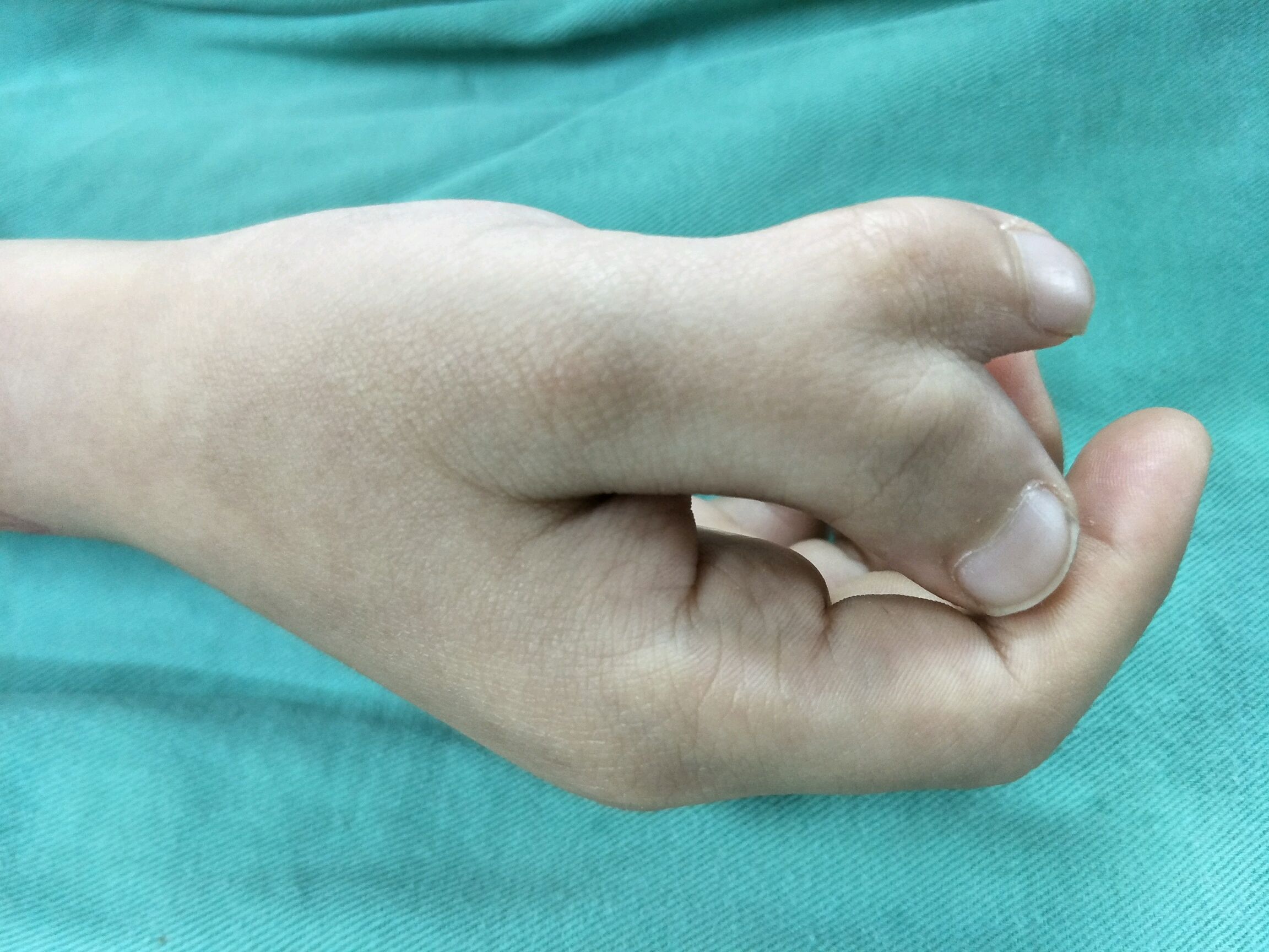 多指畸形矫形术–今天的第一台手术