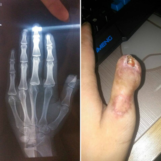 左手大拇指伤残图片图片