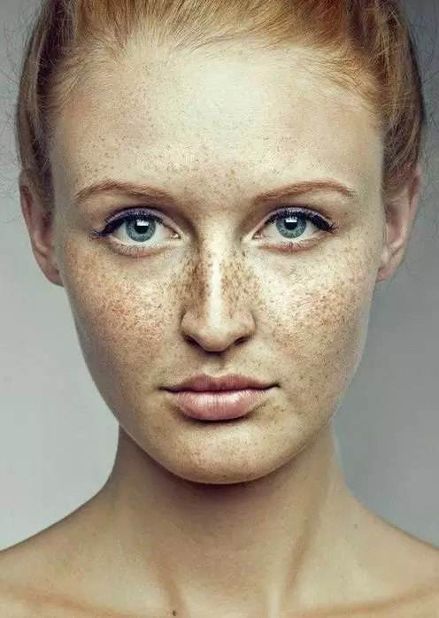 黄褐斑的皮损特点:黄褐色斑片,颜色深浅不一,表现为淡褐色,深褐色或淡