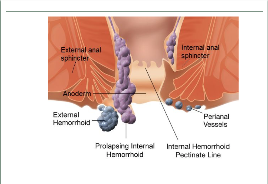 为什么体检医生说我有痔疮,我可是做完痔手术没多久
