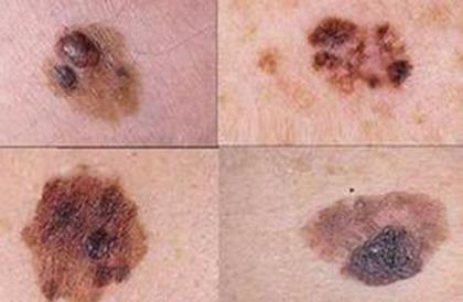 虽然只有极少数的痣会变成癌症,但是异常或非典型痣却可能随着时间