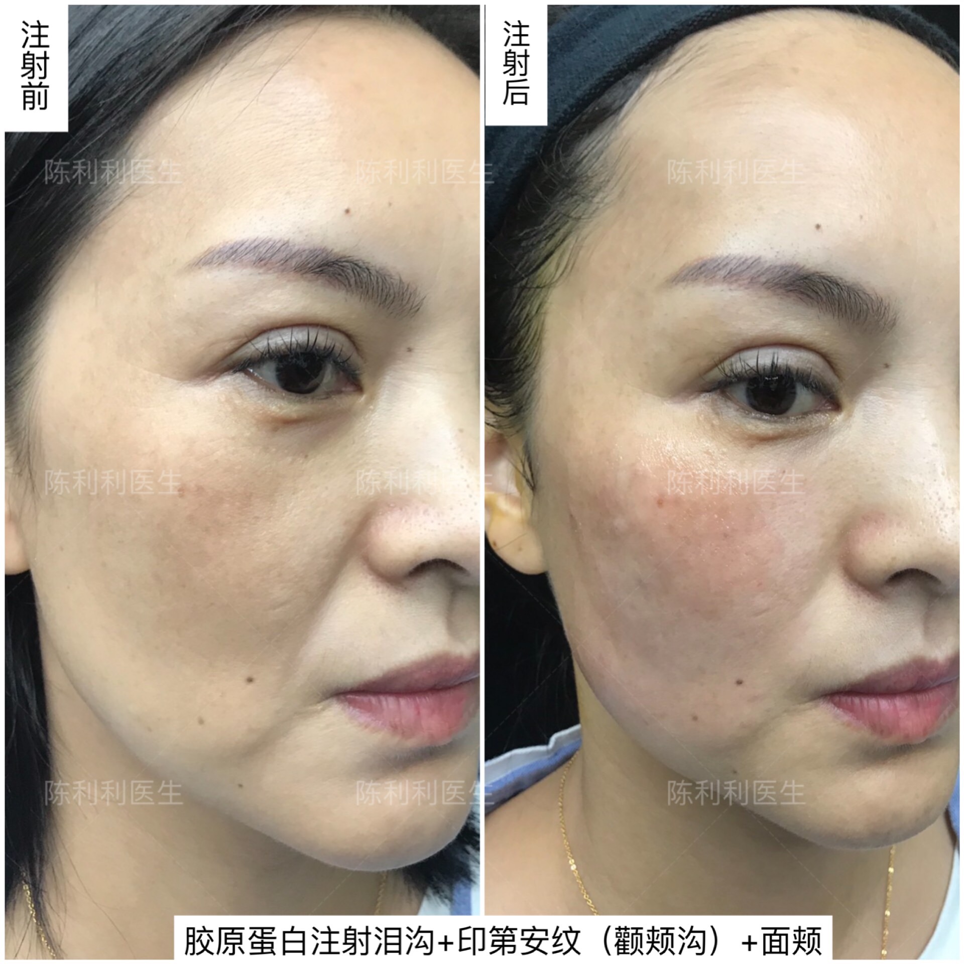 注射填充或线雕提升可以彻底解决印第安纹吗