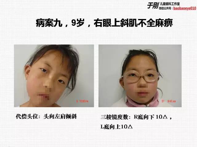 不手术也能治斜视专家讲三棱镜故事