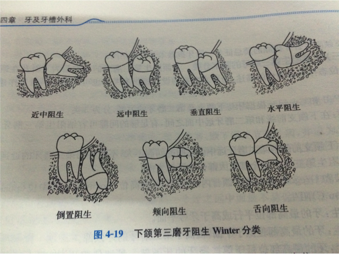 智齒的生長智齒:牙槽骨上最裡面的四顆牙叫第三磨牙(上下左右各一顆).