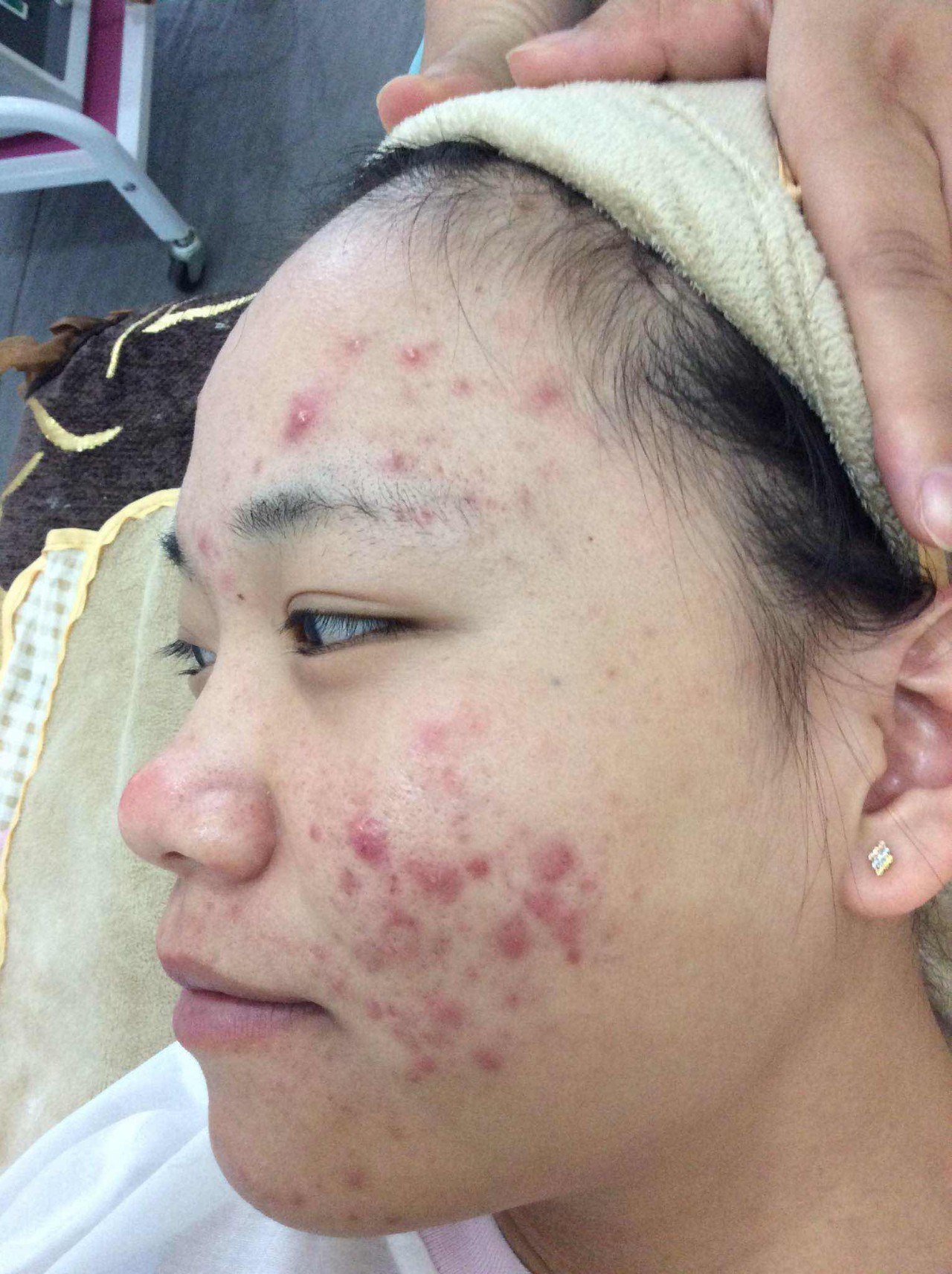 女人脸上长痘痘的原因是什么?
