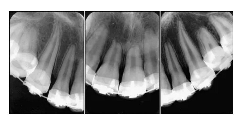 牙根吸收x光片图片