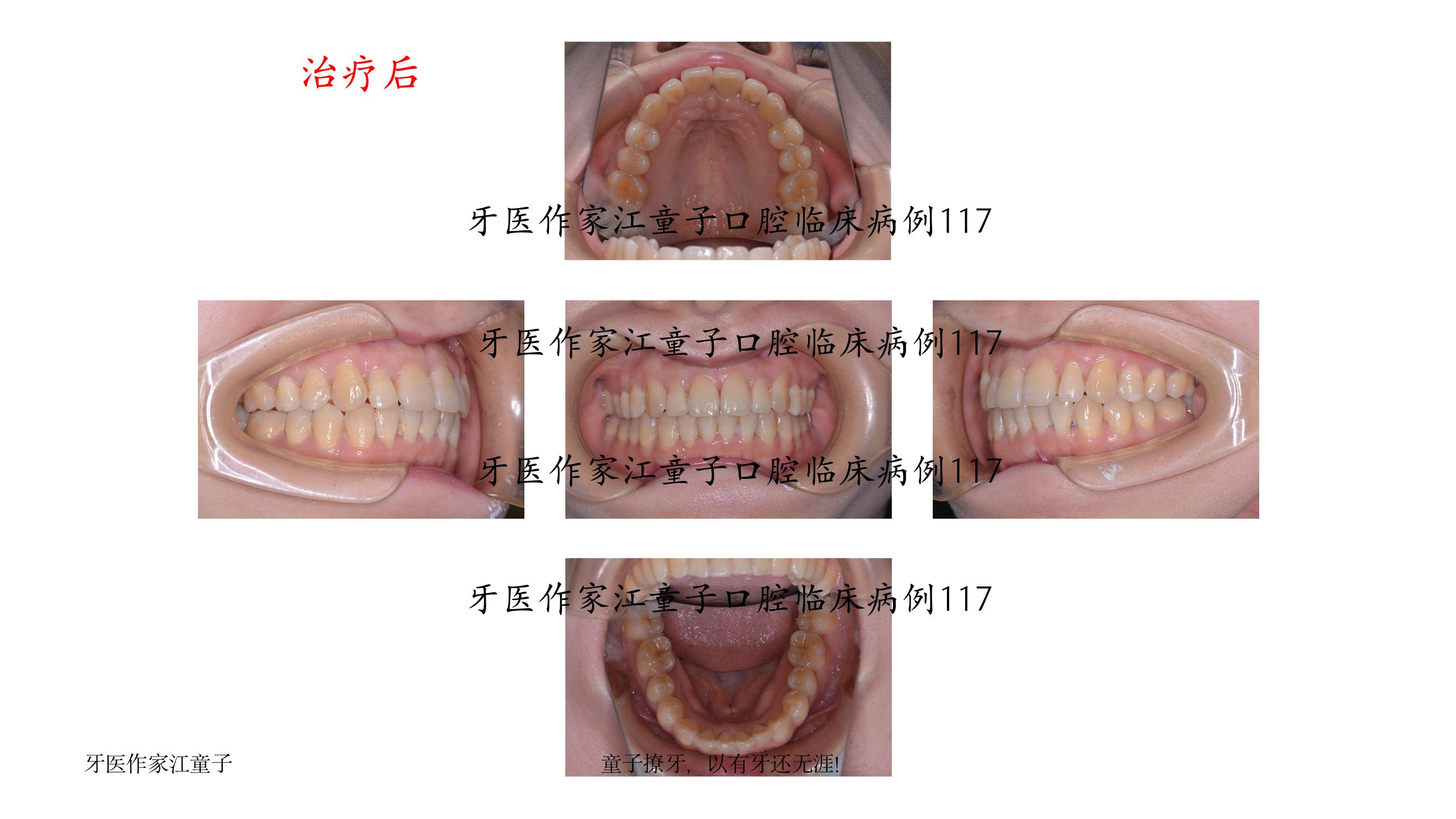 《邻面去釉(片切)在牙齿矫正中的运用》