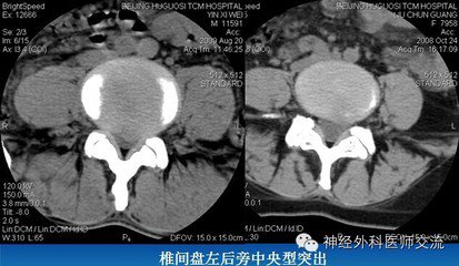 多節段脊髓型頸椎病(複雜性頸椎病),到底應該咋處理