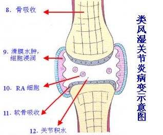 這五點可以緩解類風溼關節炎症狀,你知道嗎?-杜愛華主治醫師-愛問醫生