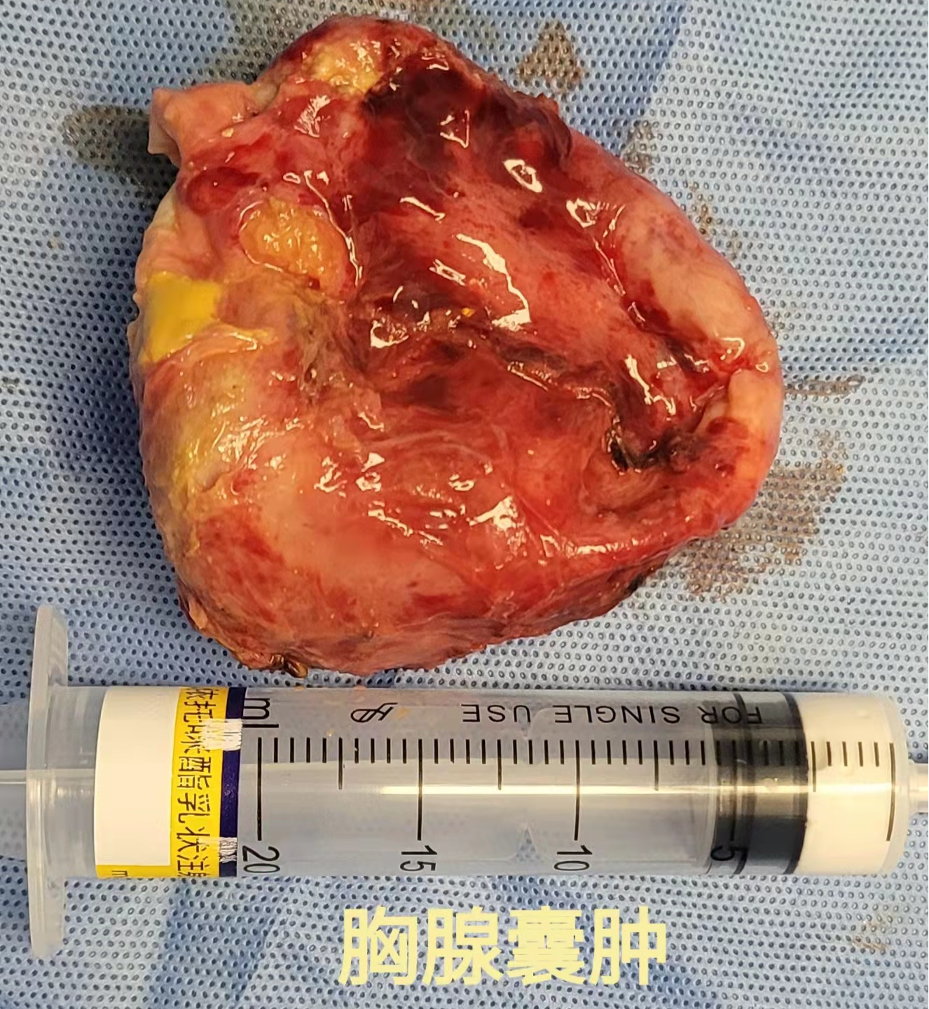 胸腔镜下成功微创切除纵隔胸腺囊肿一例