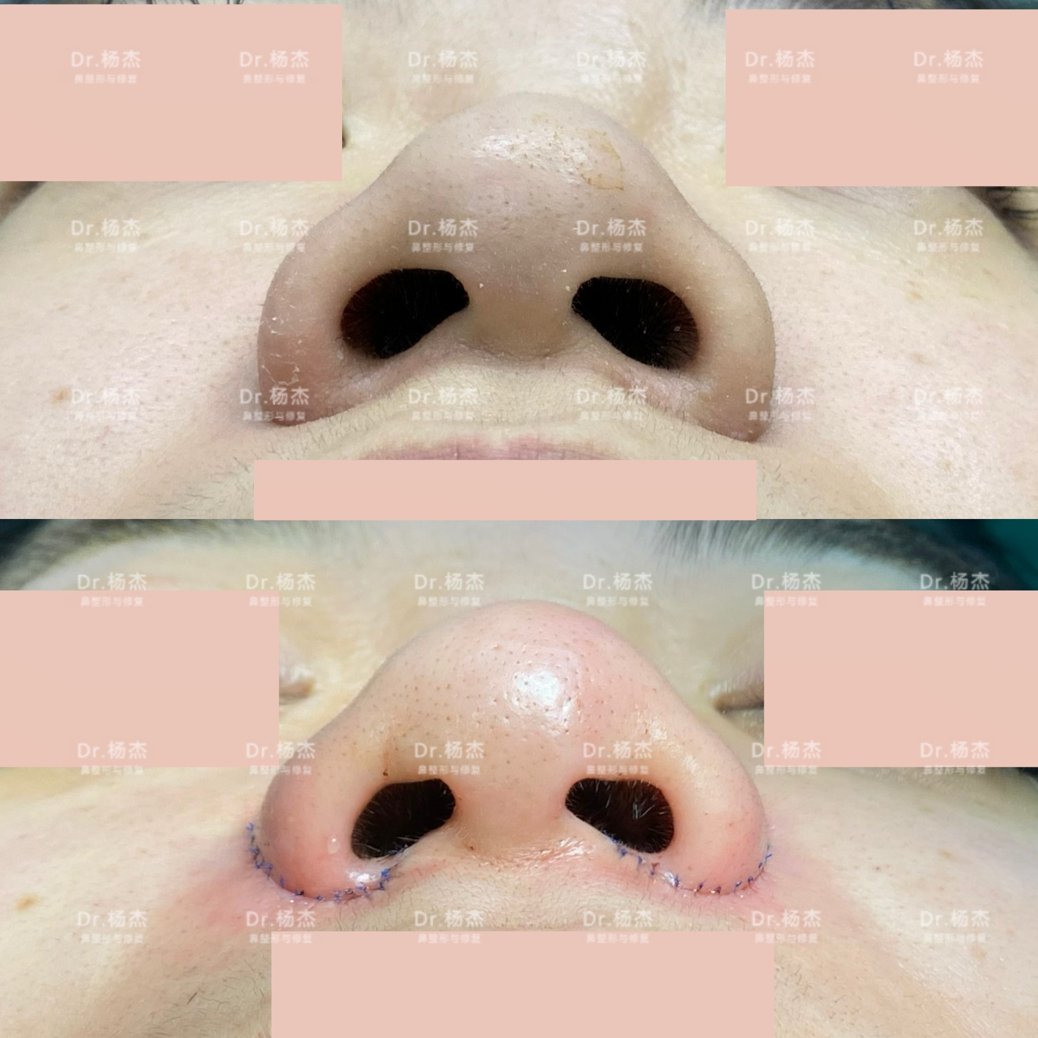 鼻腔黏膜发白图片,鼻黏膜发白鼻咽,正常鼻腔图片_大山谷图库