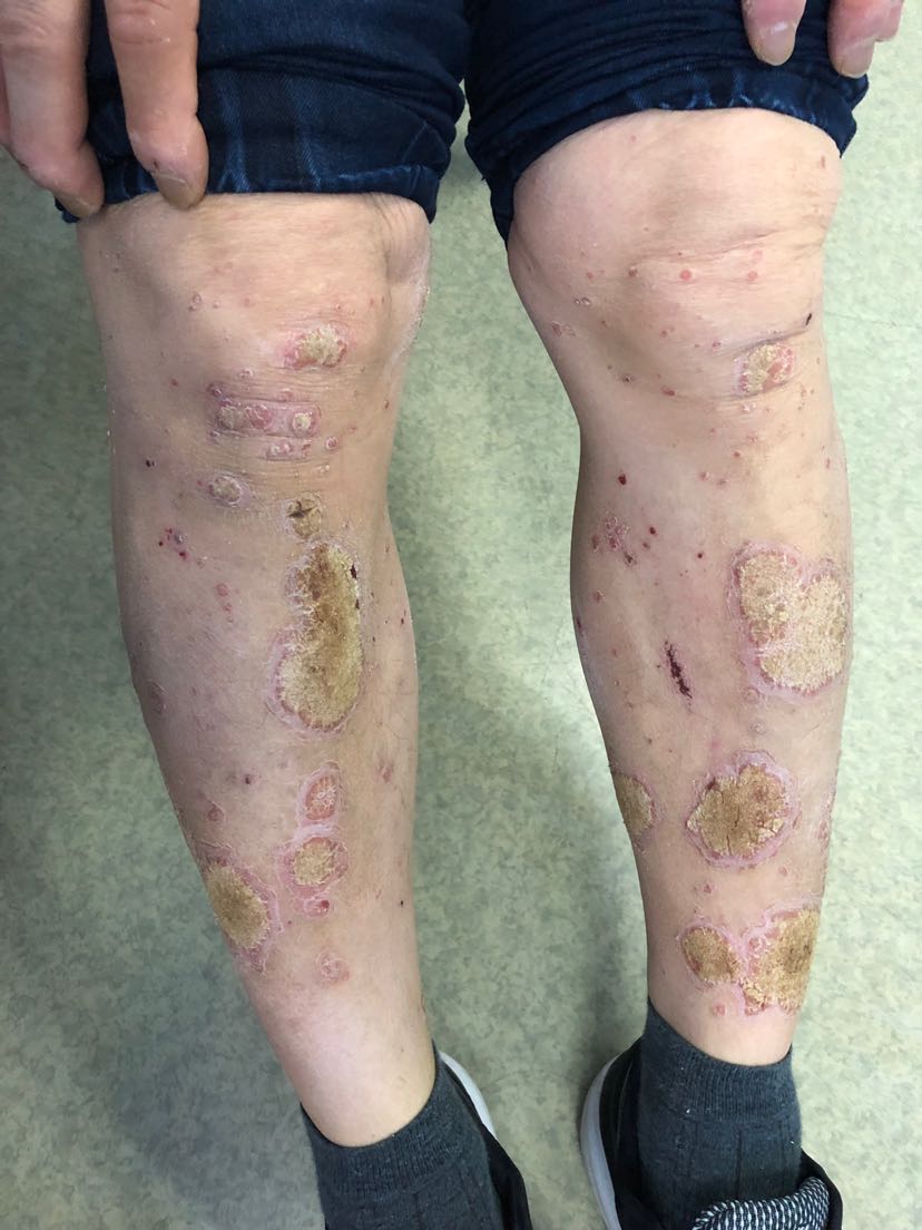 银屑病的用药原则以及日常护理