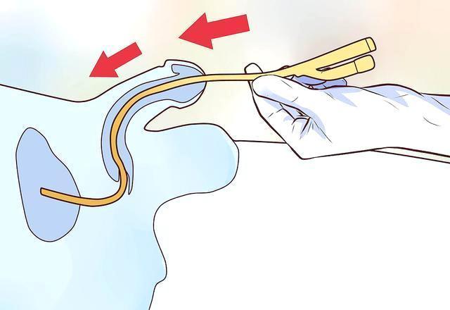 导尿管怎么拔出来图解图片