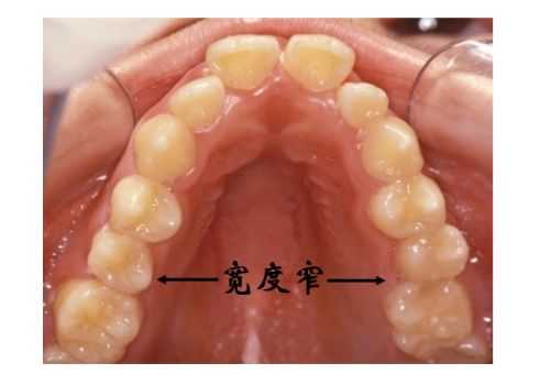 上颚弓高图片图片