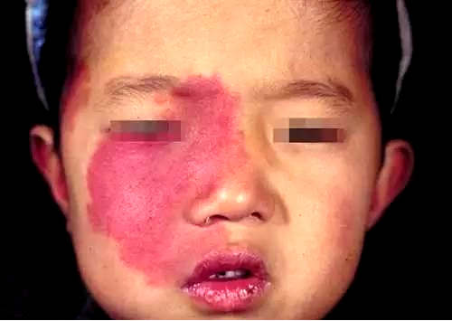 孩子身上的红斑是血管瘤,还是血管畸形,怎么区分?