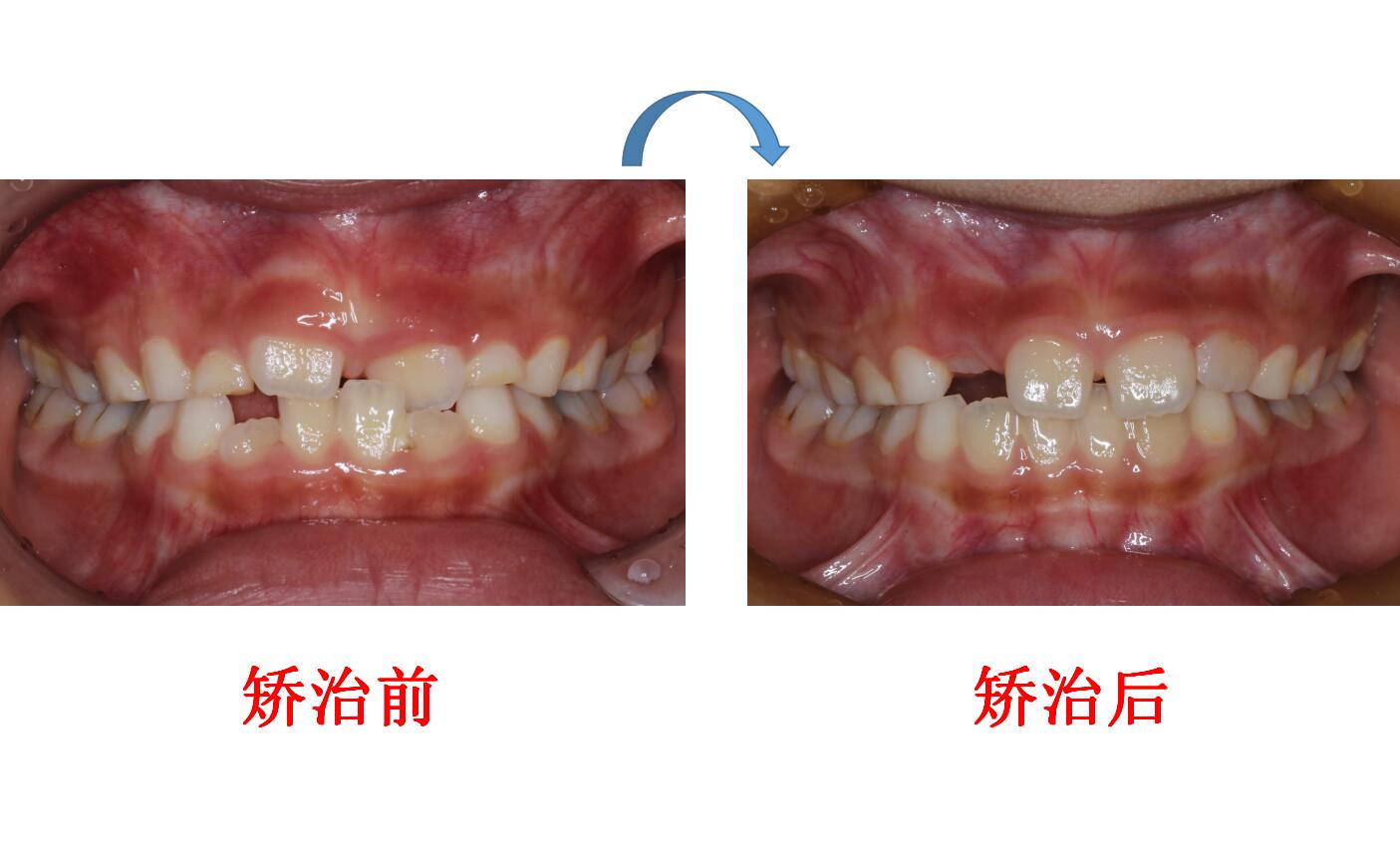 邓艳洁前牙反合矫治前后对比(1.jpg